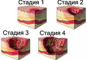 Пролежень розвиток, стадії, лікування (лікування) Пролежень розвиток, стадії, лікування
