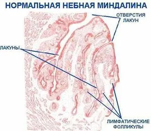 Промивання лакун мигдаликів застосування шприца і вакууму, санація піднебінних лакун мигдалин в домашніх (лакун) Промивання лакун мигдаликів застосування шприца і вакууму, санація піднебінних лакун мигдалин в домашніх