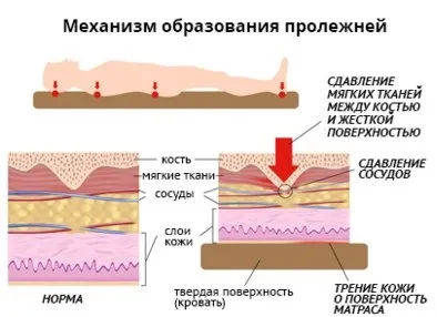 Пролежні причини, симптоми, лікування і профілактика (пролежні відмирання тканини порушення кровообіг тіло лежачий хворий причини симптоми лікування) Пролежні причини, симптоми, лікування і профілактика