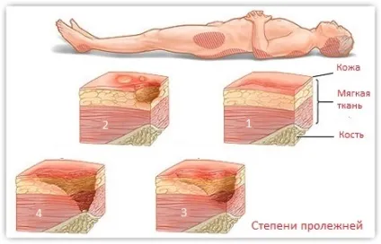 Пролежні - в чому небезпека їх освіти і як цього уникнути (компресійного впливу кровоносні судини) Пролежні - в чому небезпека їх освіти і як цього уникнути
