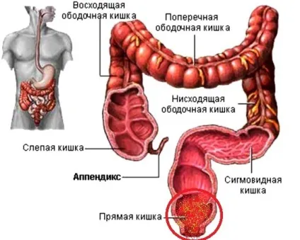 Проктит симптоми, лікування, народні засоби, дієта (проктит) Проктит симптоми, лікування, народні засоби, дієта