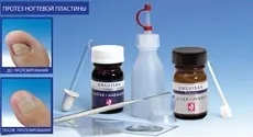 Протезування нігтьової пластини