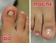Протезування нігтьової пластини