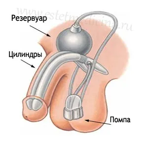Протезування статевого члена, лікування імпотенції, фаллопротезірованіе ціна, фото, відгуки, (лікування) Протезування статевого члена, лікування імпотенції, фаллопротезірованіе ціна, фото, відгуки,