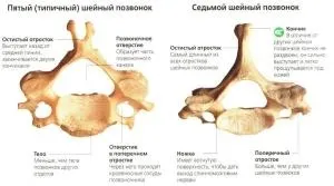 Протрузія дисків шийного відділу хребта причини, симптоми, лікування (протузія дисків) Протрузія дисків шийного відділу хребта причини, симптоми, лікування