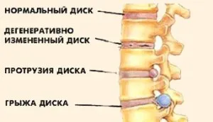 Протрузія дисків шийного відділу хребта причини, симптоми, лікування (шийного) Протрузія дисків шийного відділу хребта причини, симптоми, лікування
