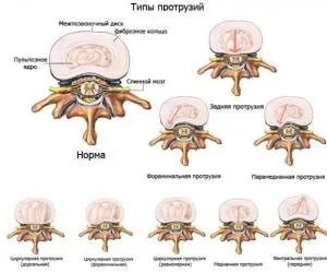 Протрузія дисків шийного відділу хребта причини, симптоми, лікування (протрузія) Протрузія дисків шийного відділу хребта причини, симптоми, лікування