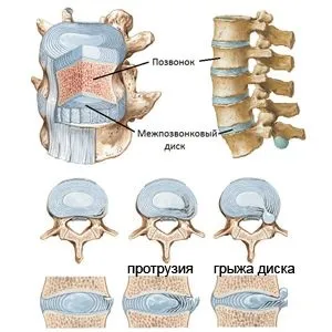 Протрузія грудного відділу хребта симптоми і лікування (протрузія) Протрузія грудного відділу хребта симптоми і лікування