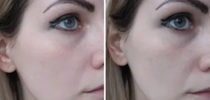 Пудра clinique відгуки про матувальним засобом для проблемної шкіри almost powder makeup spf 15 (clinique) Пудра clinique відгуки про матувальним засобом для проблемної шкіри almost powder makeup spf 15