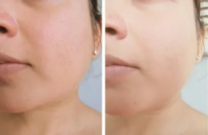 Пудра clinique відгуки про матувальним засобом для проблемної шкіри almost powder makeup spf 15 (проблемної) Пудра clinique відгуки про матувальним засобом для проблемної шкіри almost powder makeup spf 15
