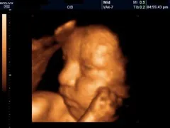 Розрахуйте узі плода самостійно, мітки пвп, розшифровка, що, вагітність, абревіатура (самостійно) Розрахуйте узі плода самостійно, мітки пвп, розшифровка, що, вагітність, абревіатура