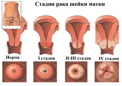 Рак шийки матки