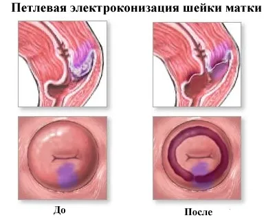 Рак шийки матки