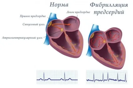 Радіочастотна абляція серця показання, ускладнення (серця) Радіочастотна абляція серця показання, ускладнення