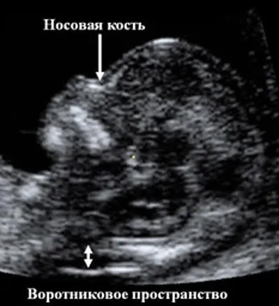 Розшифровка скорочень узі при вагітності - блог моя бетешка (товщини комірного простору) Розшифровка скорочень узі при вагітності - блог моя бетешка