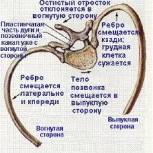 Реберний горб причини, симптоми, лікування (реберний) Реберний горб причини, симптоми, лікування