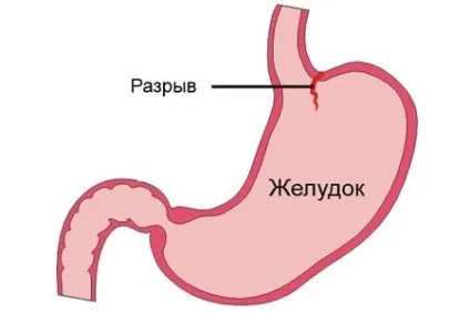 Розрив кишечника симптоми і причини (розрив) Розрив кишечника симптоми і причини