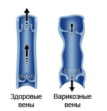 Ретикулярний варикоз що робити