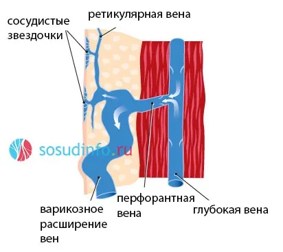Ретикулярний варикоз що це, причини, лікування (лікування ретикулярного варикозу) Ретикулярний варикоз що це, причини, лікування