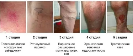 Ретикулярний варикоз що це, причини, лікування (ретикулярний) Ретикулярний варикоз що це, причини, лікування