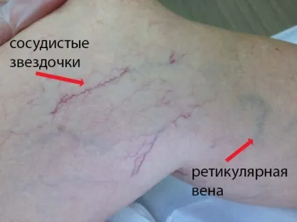 Ретикулярний варикоз що це, причини, лікування (причини) Ретикулярний варикоз що це, причини, лікування