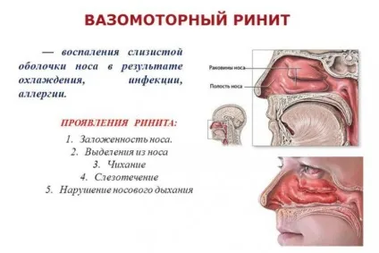 Риніт вазомоторний операція і особливості хірургічного втручання, протипоказання і (хірургічного) Риніт вазомоторний операція і особливості хірургічного втручання, протипоказання і