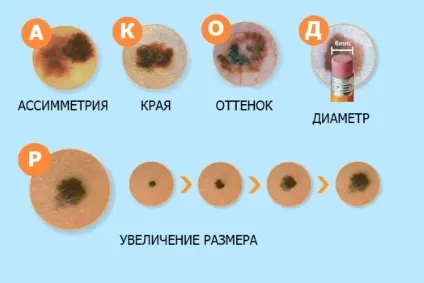 Родимка і меланома, як відрізнити ознаки симптоми (родимка) Родимка і меланома, як відрізнити ознаки симптоми