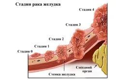 Блювота кавовою гущею (чорна блювота) причини (блювота) Блювота кавовою гущею (чорна блювота) причини
