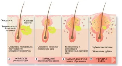 Сальні пробки на обличчі як позбутися від розширених пор на обличчі і сальних пробок (пробки) Сальні пробки на обличчі як позбутися від розширених пор на обличчі і сальних пробок