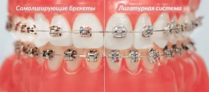 Самолігуючі брекети види, переваги і недоліки (самолігуючі) Самолігуючі брекети види, переваги і недоліки