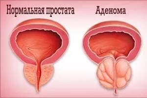 Залишкова сеча у чоловіків поширені причини (причини) Залишкова сеча у чоловіків поширені причини