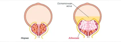 Залишкова сеча при аденомі простати у чоловіків (чоловіків) Залишкова сеча при аденомі простати у чоловіків