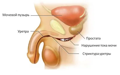 Залишкова сеча у чоловіків в сечовому міхурі норма і патологія (нормальний обсяг залишкової сечі у чоловіків) Залишкова сеча у чоловіків в сечовому міхурі норма і патологія