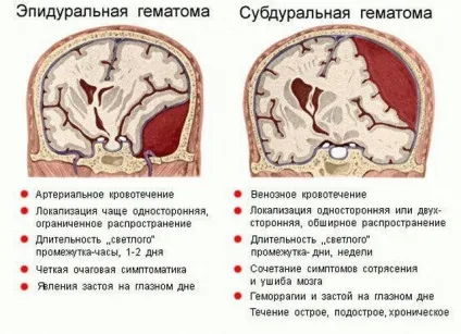Гостра і хронічна епідуральна гематома головного мозку лікування і наслідки (гостра епідуральна гематома) Гостра і хронічна епідуральна гематома головного мозку лікування і наслідки