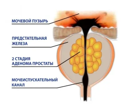Залишкова сеча при аденомі простати у чоловіків (чоловіків) Залишкова сеча при аденомі простати у чоловіків