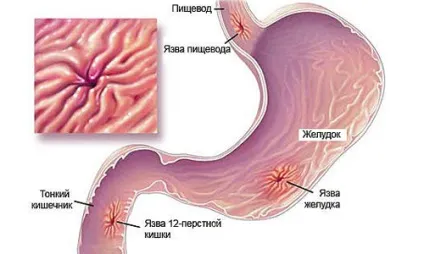 Насіння льону при гастриті і виразці шлунка (насіння) Насіння льону при гастриті і виразці шлунка