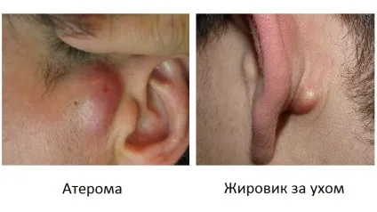 Шишка біля вуха ближче до щоки що це за ущільнення (щоці) Шишка біля вуха ближче до щоки що це за ущільнення