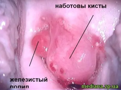 Шийка матки фото до і після лікування