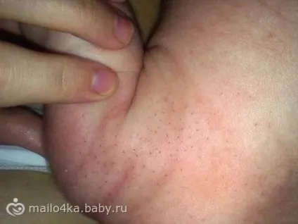 Щетина у малюків
