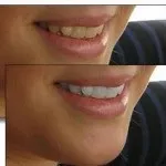 Система домашнього відбілювання hollywood smile (домашнього) Система домашнього відбілювання hollywood smile