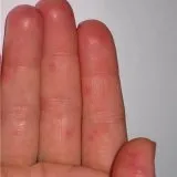 Висип на ліктях і колінах (колінах) Висип на ліктях і колінах