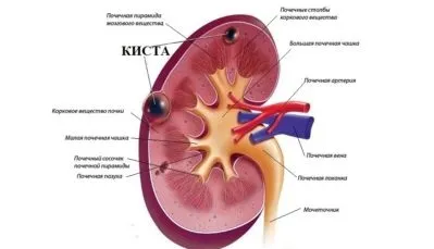 Синусова кіста лівої нирки