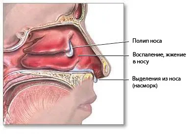 Симптоми поліпів в носі - фото, діагностика та причини поліпів в носі (поліпів) Симптоми поліпів в носі - фото, діагностика та причини поліпів в носі