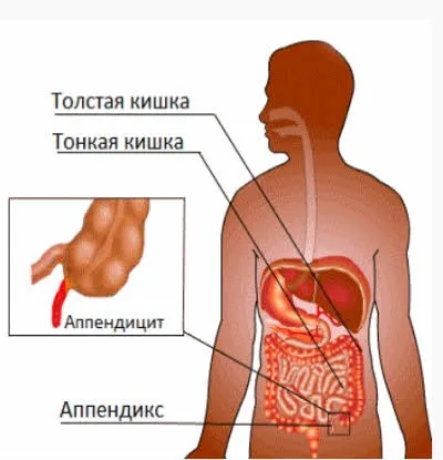 Симптоми апендициту у дорослих перші ознаки апендициту у жінок і чоловіків