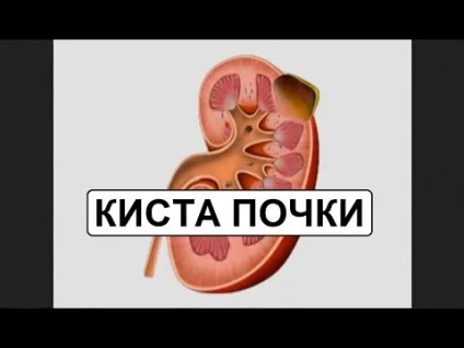 Синусова кіста нирки що це таке, причини виникнення та лікування