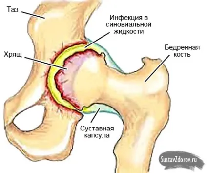 Симптоми артриту повний опис всіх характерних ознак (симптоми) Симптоми артриту повний опис всіх характерних ознак