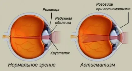 Складний астигматизм як проводитися лікування патології (астигматизму дітей дорослих) Складний астигматизм як проводитися лікування патології