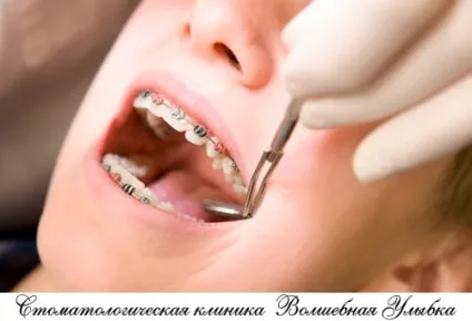 Зняття брекетів з зубів по відмінною ціною! (Зняття брекетів зубів) Зняття брекетів з зубів по відмінною ціною!
