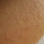 Папіломи на шиї причини появи, лікування в домашніх умовах, профілактика (домашніх) Папіломи на шиї причини появи, лікування в домашніх умовах, профілактика