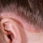 Папіломи на шиї причини появи, лікування в домашніх умовах, профілактика (папіломи) Папіломи на шиї причини появи, лікування в домашніх умовах, профілактика